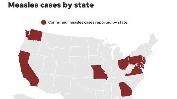 U.S. Health Professionals Retrain to Identify and Manage Measles Amidst Outbreaks