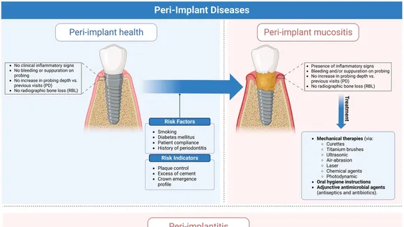 Exploring the Microbiota in Peri-Implant Diseases: A Leap Towards Precision Medicine in Dentistry