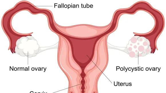 Understanding Polycystic Ovary Syndrome (PCOS): Risks, Symptoms and Management