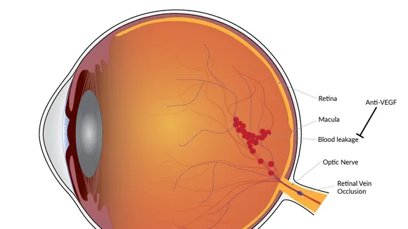 The Future of Retinal Disease Treatment: New Therapies on the Horizon