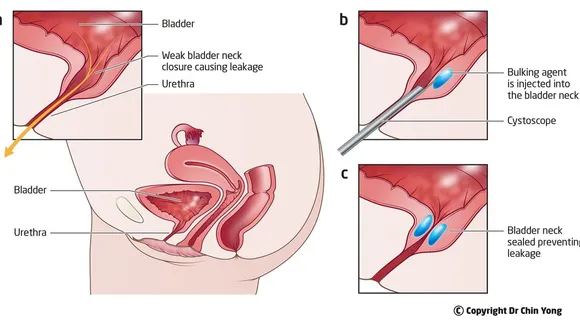 Understanding Stress Urinary Incontinence in Women: Surgical Treatments and Considerations