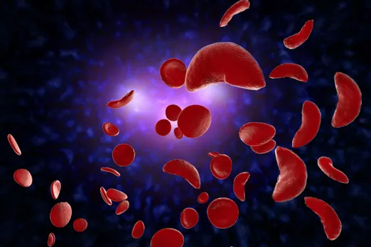 Sickle cell anaemia 11 times deadlier than thought, study finds