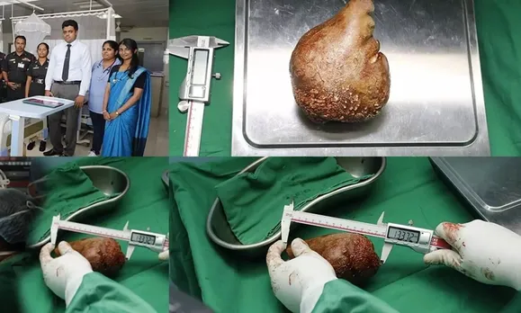 Sri Lankan Army doctors set Guinness World Record by removing world's largest kidney stone