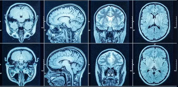 Long COVID patients are much more likely to have multiple organ abnormalities