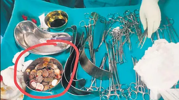 187 coins removed from schizophrenia patient's stomach in Karnataka