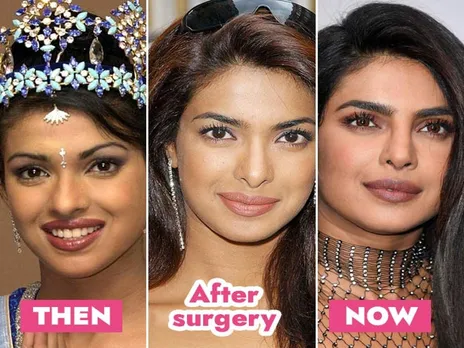 Priyanka Chopra Jonas on botched nose job: I went into deep depression