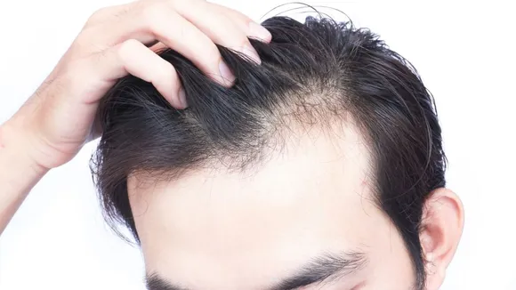 The hidden racist history of hair loss