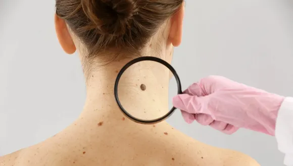 Skin cancer screening guidelines can seem confusing – three skin cancer researchers explain when to consider getting checked