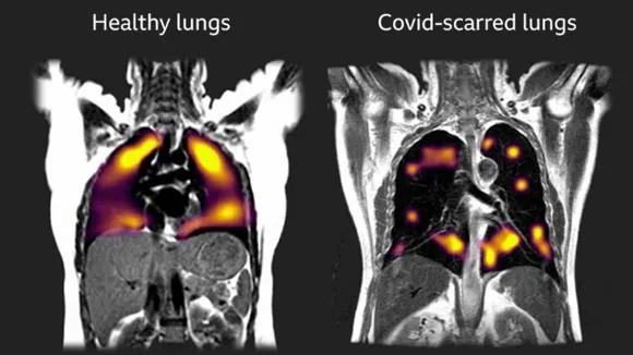 COVID-19 can cause lasting lung damage â 3 ways long COVID patients' respiration can suffer