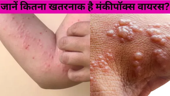 Symptoms Of Monkeypox Virus (1)