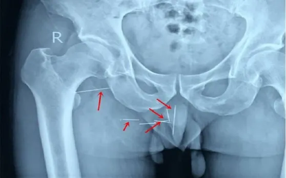 10 साल से कूल्हों में हो रहा था भयानक दर्द, X-Ray रिपोर्ट में सामने आई ऐसी सच्चाई.. नहीं होगा यकीन