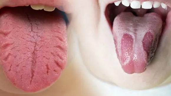 Tongue burn remedy