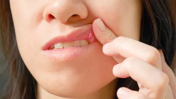 mouth ulcer