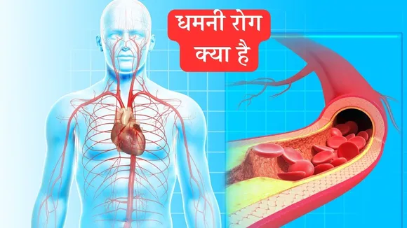 Artery Disease