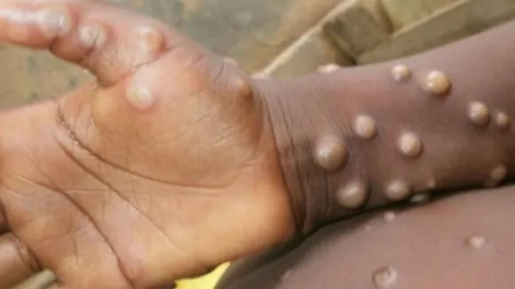 United Arab Emirates Reports 1st Case of Monkeypox