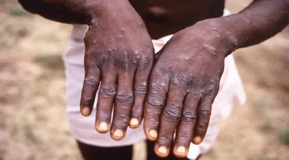 Two More Monkeypox Cases In India