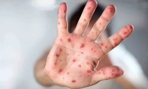 Health Experts Warns about Tomato Flu, Says Virus ‘Very Contagious’