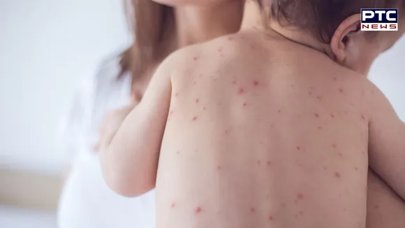 Toronto infant hospitalised with measles; officials urge vaccination amid concerns