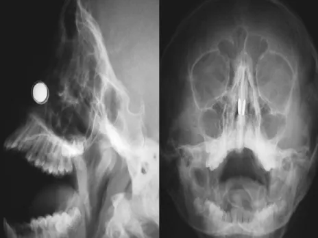 Magnets removed from boy's nose in an creative way.