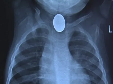 If swallowed, button cell batteries can badly burn a child’s throat