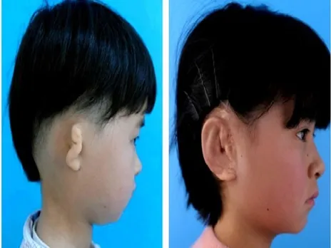 Chinese scientists have given five children new ears grown in lab