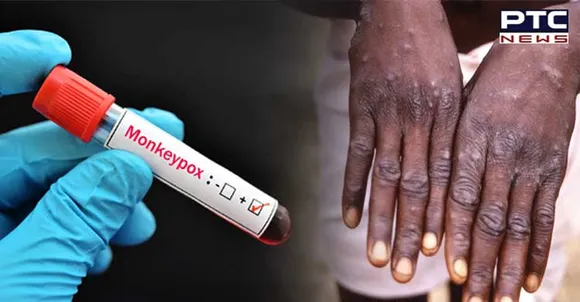 Canada confirms 477 cases of monkeypox