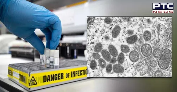 Man tests positive for Covid, Monkeypox and HIV at same time