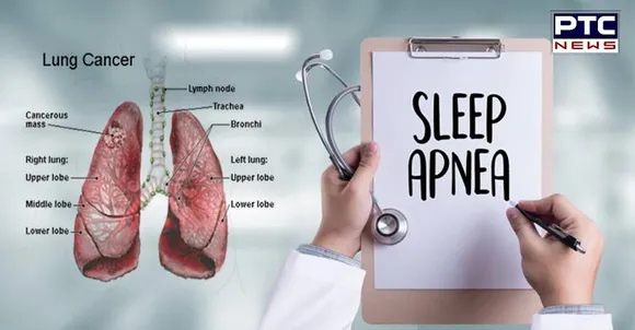 Sleep apnea can lead to lung cancer at young age