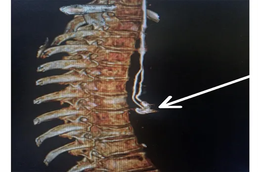 teeth stuck in esophagus