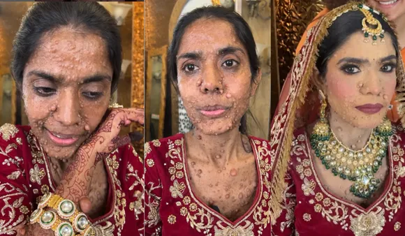 Watch: Bride With Skin Condition Shares Heartwarming Story Of Acceptance