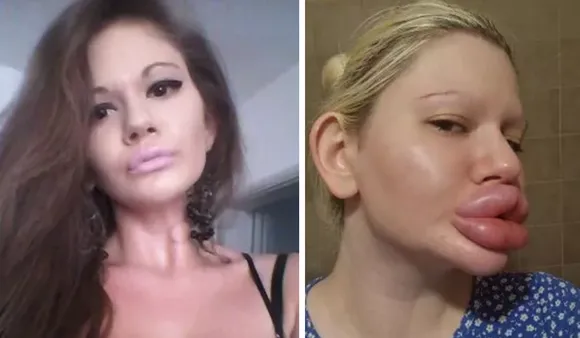 World's Biggest Lips: Woman Undergoes Six Lip Surgeries In One Day