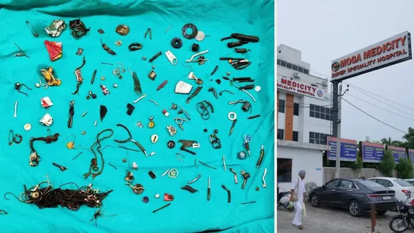 Punjab: Over 60 Objects Removed From Man's Stomach