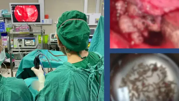 Thai Woman Suffering From Stuffy Nose Finds Maggots Inside Nostrils
