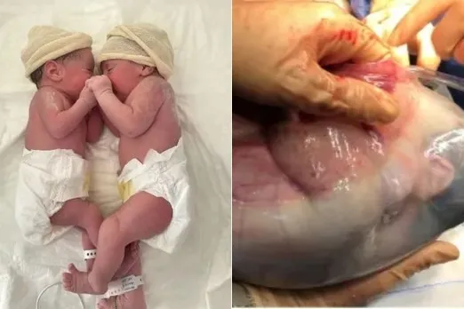 What Is Mermaid Birth? Spanish Twins Have One In 80,000 Rare Birth