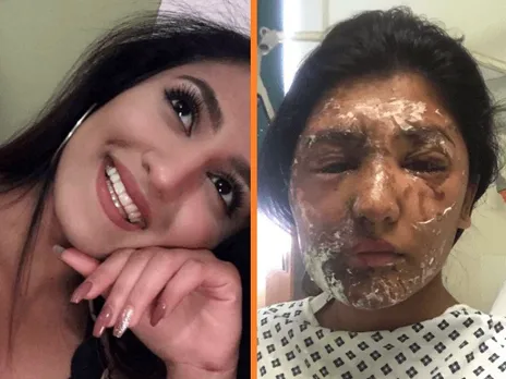 Aspiring Model Attacked With Acid In London On 21st Birthday
