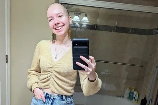 Alopecia Patient Woman Shares Inspiring Story Of Exploring Self-Love