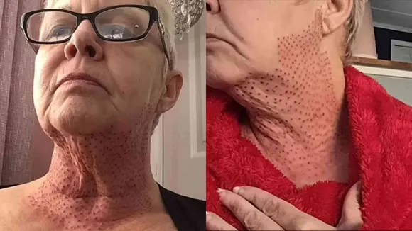 59-Year-Old Woman Left With "Lizard Neck" After Botched Double Chin Surgery