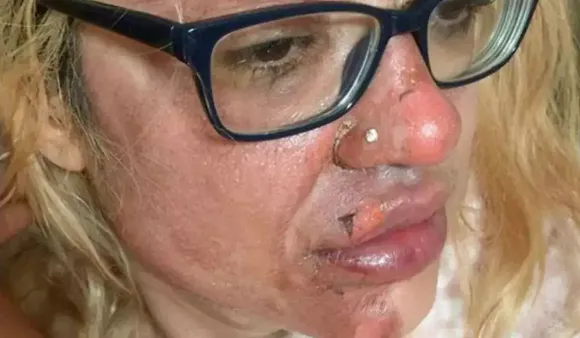 Woman Tries TikTok Hack, Peels Off Face In Horrifying Accident