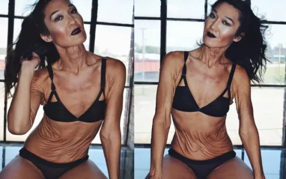 Woman With Rare Skin Condition Poses For Pictures To Raise Awareness