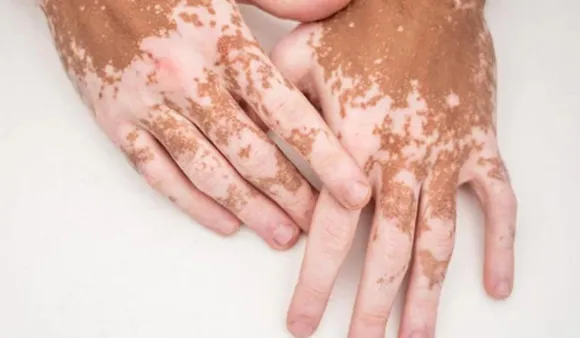 Celebrating Vitiligo: Beauty Is Accepting Differently-Looking Skin