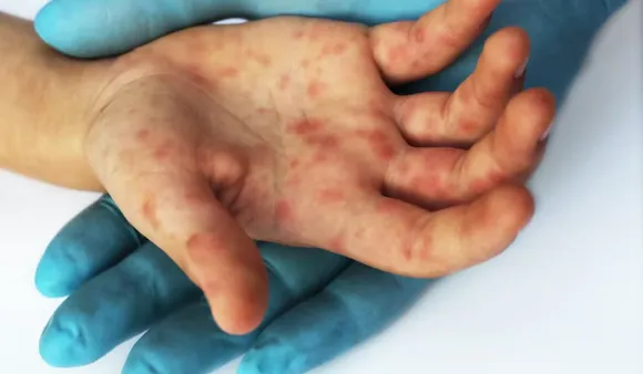 Increasing Measles Cases Likely Driven By COVID-19 Pandemic