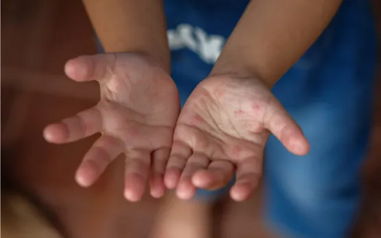 Hand, Foot And Mouth Disease: What Every Parent Should Know About It