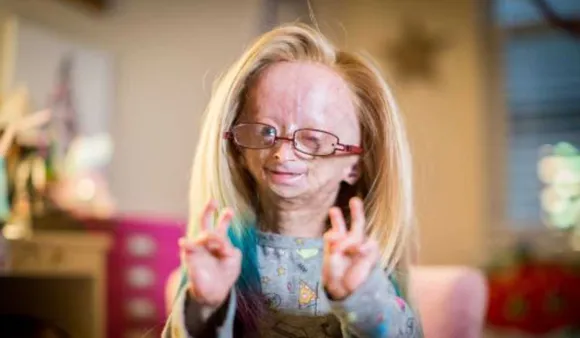 Adalia Rose Williams: Influencer With Progeria Bids Farewell To The World At 15
