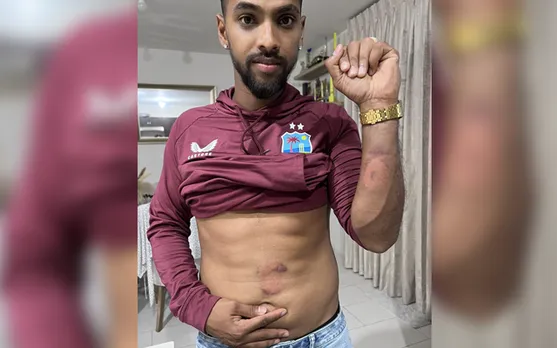 ‘Arshdeep be like ye too humra pyaar h Pooran Bhai’ - Fans react as Nicholas Pooran shares pictures of his bruises after T20I series win against India