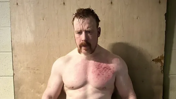 Sheamus displays battle scars after the intense match with Ludwig Kaiser on WWE raw