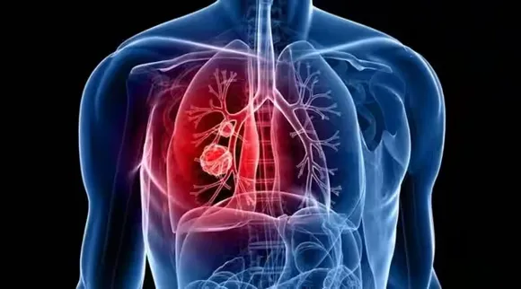 World Lung Cancer Day 2023: நுரையீரல் டிடாக்ஸ் என்றால் என்ன?
