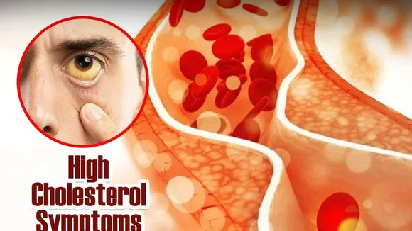 Silent Killer: High Cholesterol Symptoms Often Ignored