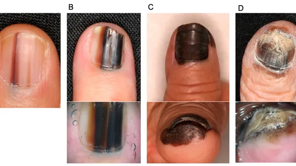 Dermatologist Warns: Dark Vertical Line on Nail Could Indicate Rare Skin Cancer