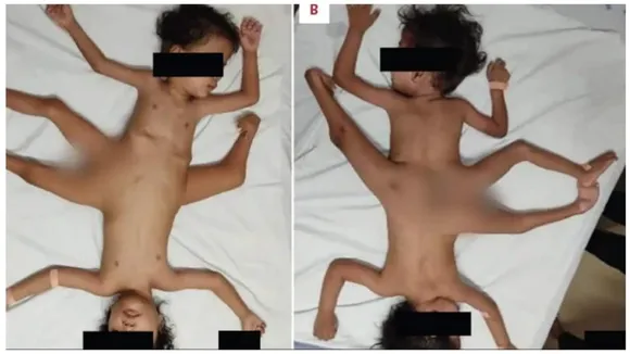 Indonesian Conjoined Twins Thrive After Complex Surgery