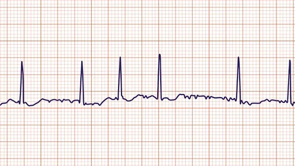 Atrial Fibrillation Increasingly Common and Risky in Younger Adults, Study Finds